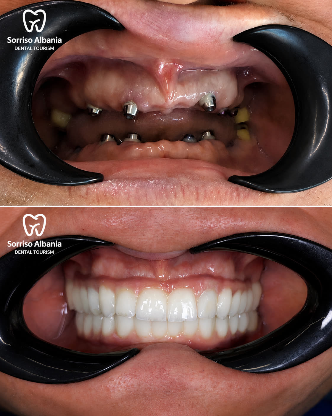 Prima e dopo: riabilitazione completa su impianti dentali, doppia arcata