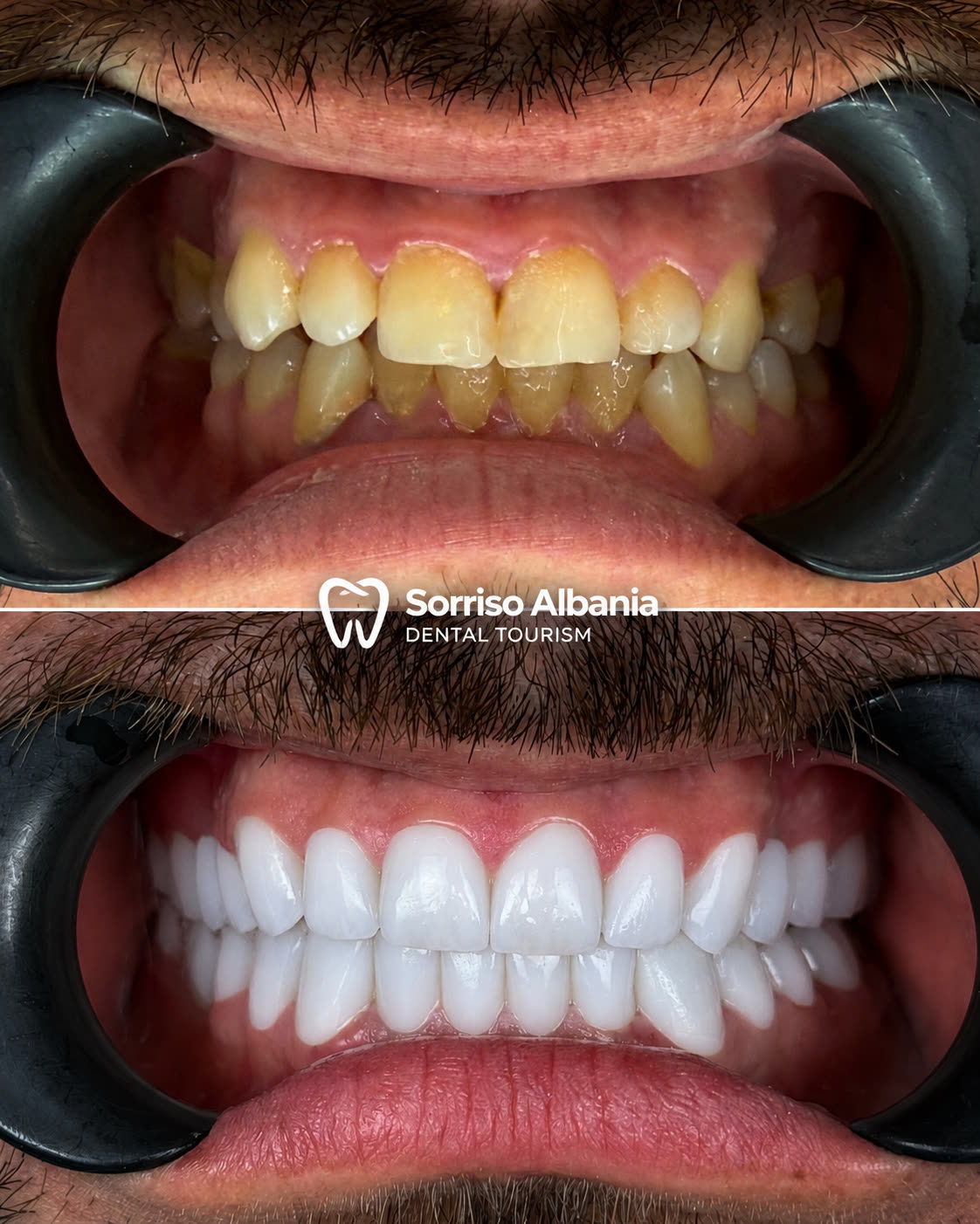 Prima e dopo: faccette dentali in ceramica