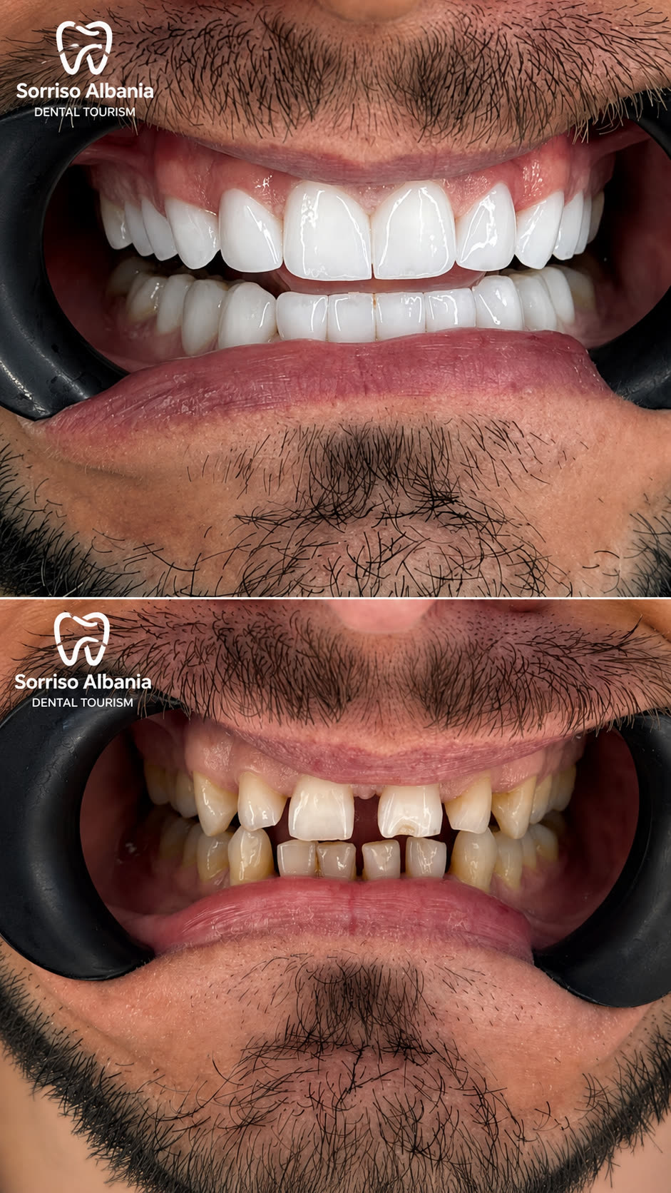 Prima e dopo: faccette dentali con chiusura del diastema