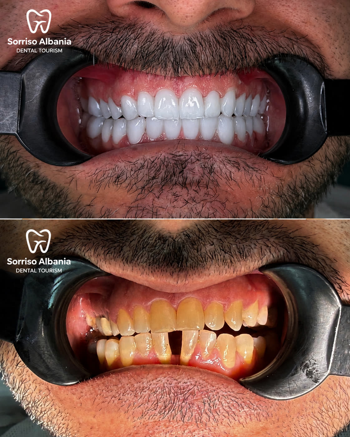 Prima e dopo: faccette dentali in ceramica, primo piano
