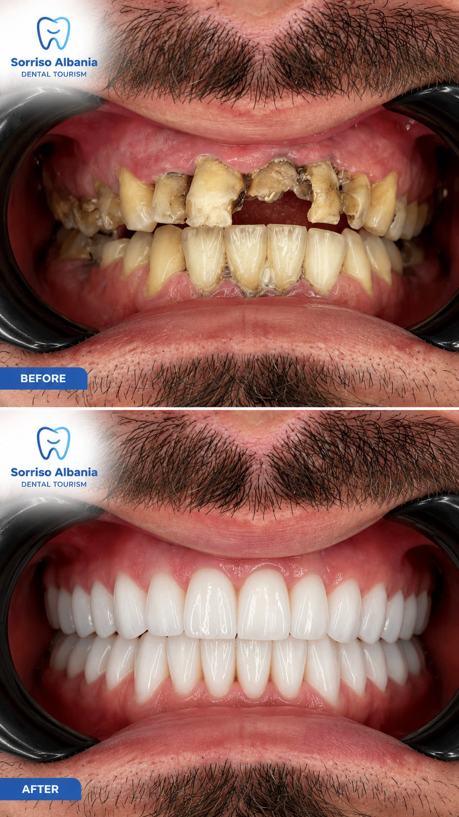 Prima e dopo: riabilitazione completa di denti fratturati e compromessi