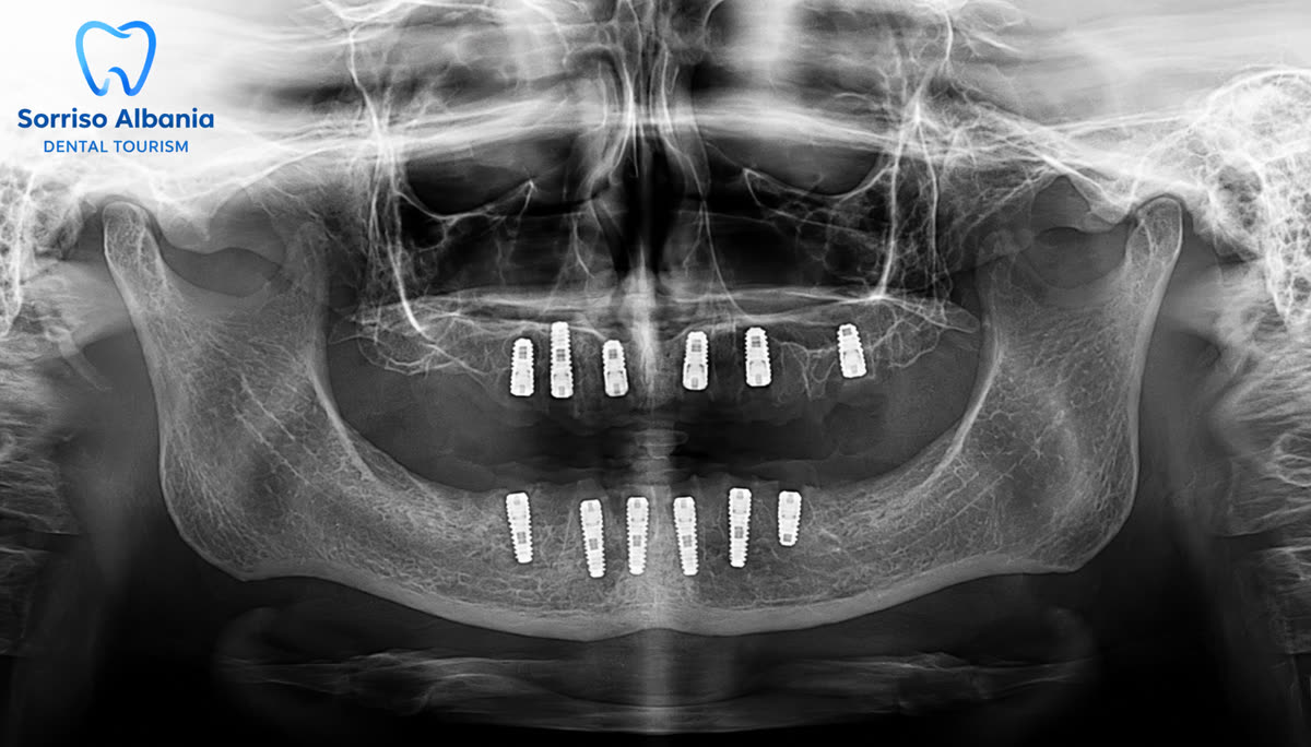 Radiografia panoramica di controllo dopo l’inserimento degli impianti